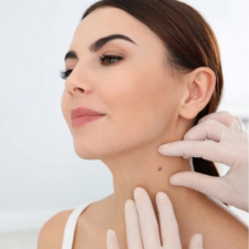 xóa nốt ruồi, mụn thịt